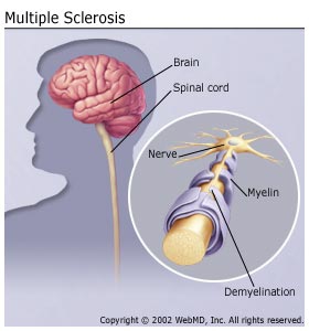  Scoliosis, Multiple Sclerosis, MS, Extreme tiredness, Dizzy, Dizziness, Weak, Fog, Sclerosis